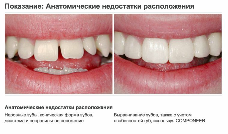 Anomalieën van de tanden op de achtergrond van systemische hypoplasie