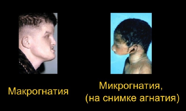 Macrognathy is an abnormal enlargement of the jaw with severe consequences