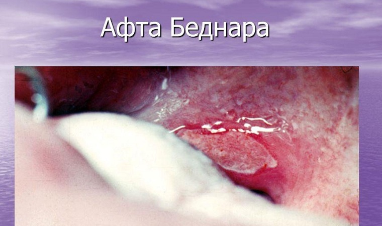 Bednar's Afts: causes, symptoms, treatment and prevention of ulcers