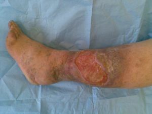 Úlcera trófica de la pierna