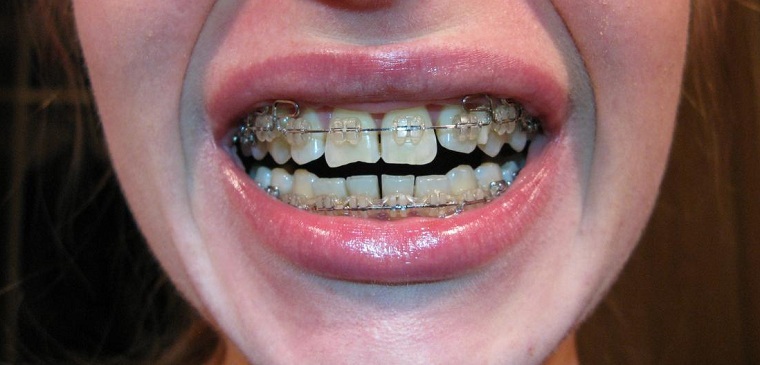 Separazione dei denti come una delle varianti del trattamento ortodontico