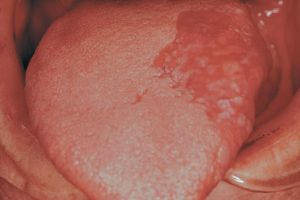 Erythroplasty ir bīstama pirmsvēža slimība, kas ietekmē gļotādas