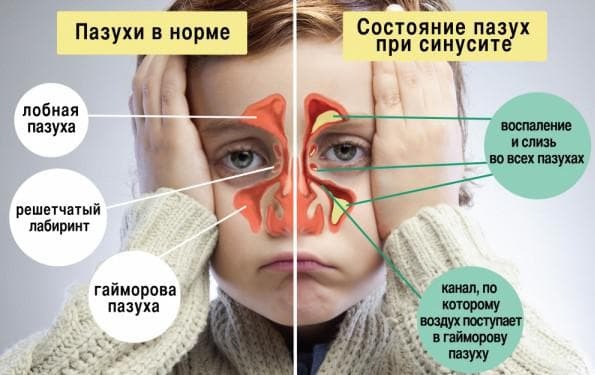 sinusitis in the child symptoms and treatment