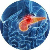 Symptomy, diagnostika a léčba rakoviny pankreatu