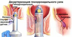 desarteration of the hemorrhoidal node