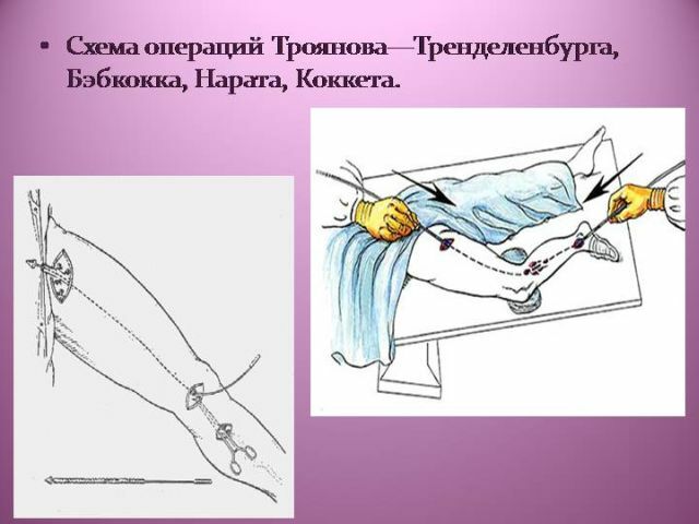 Operacija Trianelenburg Troyanov - kirurški poseg na podkožno veno