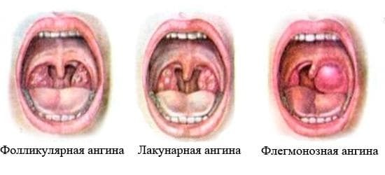 follicular sore throat