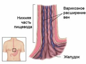 Les varices de l'oesophage - la classification et l'étendue de la maladie, les méthodes de traitement