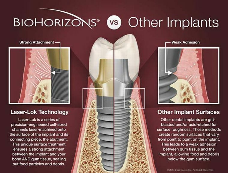 BioHorizons: implantes dentales estadounidenses de calidad y asequibles