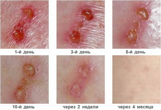 The use of Argosulfan ointment for trophic ulcers