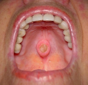 השתלת שיניים: התוויות נגד וסיבוכים