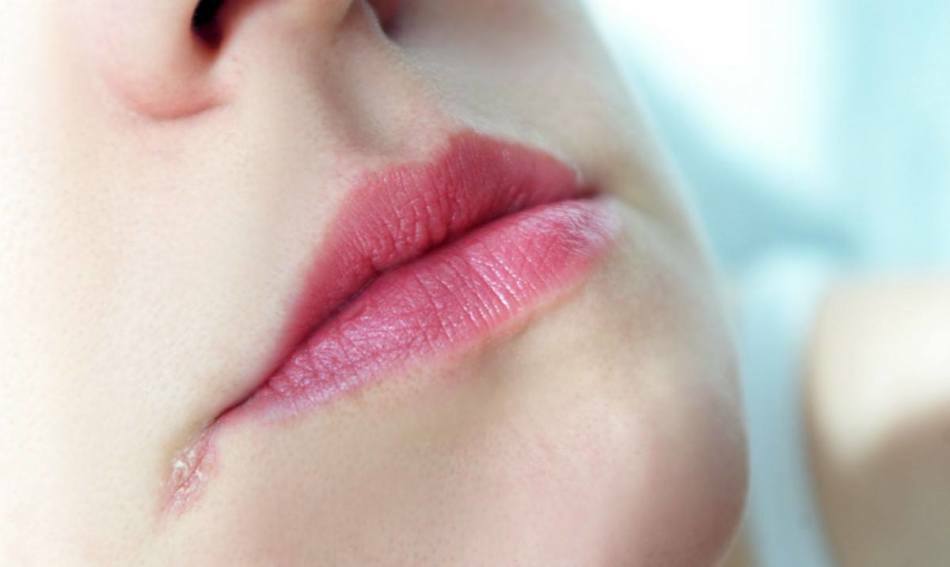 Boala de buze - cheilita: simptome și cauze. Tratamentul cheilitei la copii și adulți. Unguente și remedii folclorice pentru cheilită
