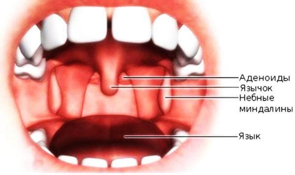 treatment of the cyst of the palatine tonsil