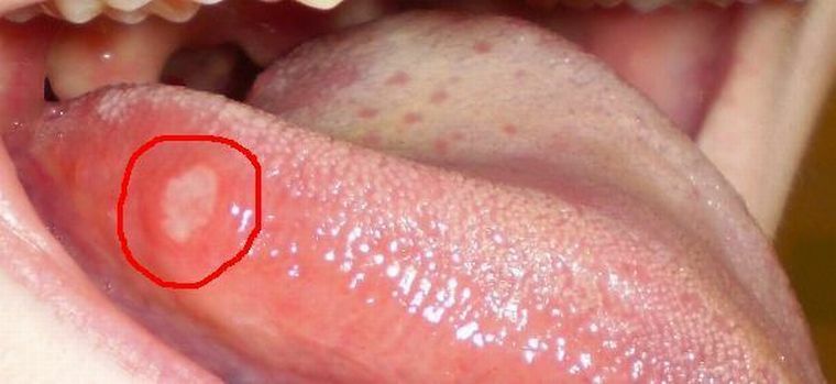 ¿Por qué aparecen jazvochki en la lengua y cómo curar las llagas?