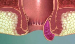 Lacné a účinné masti na liečbu vonkajších hemoroidov