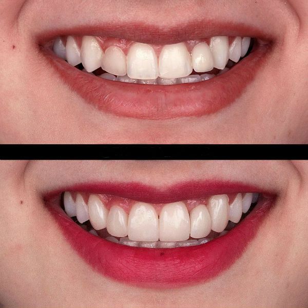 Quels sont les placages, leurs types et la méthode d'installation sur les dents?