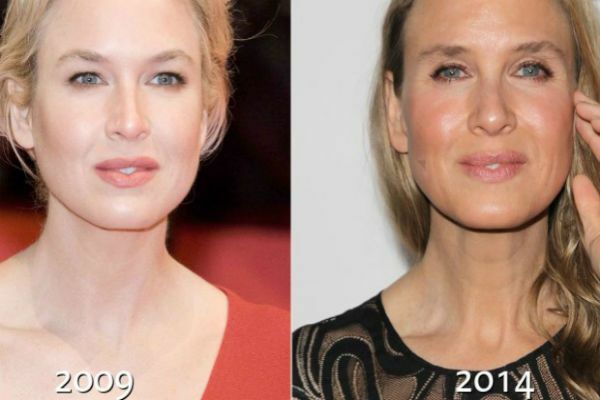 Photos of actress Renee Zellweger - before and after plastics