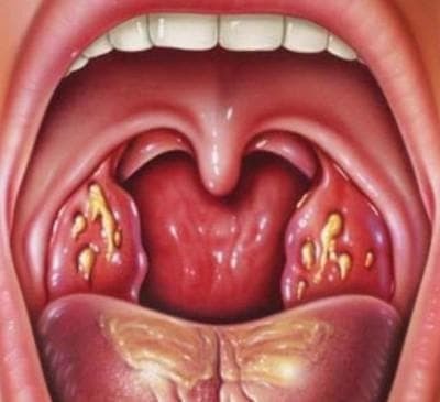 herpetic sore throat in children