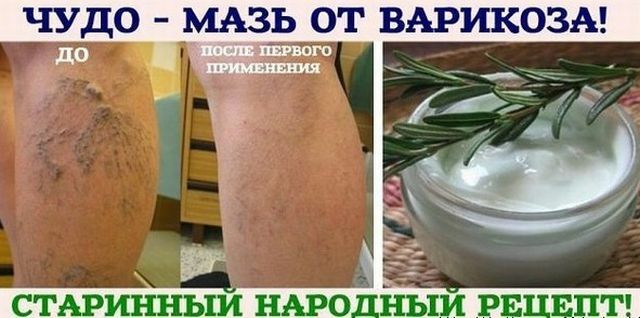 Is a miracle ointment helping to get rid of varicose veins: a prescription and tips for use