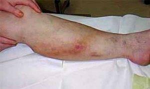phlebitis of the lower extremities