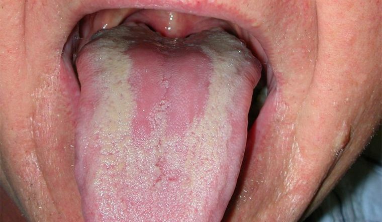 Candida-Glossitis - Was ist, wenn sich der Pilz auf der Zunge festgesetzt hat?