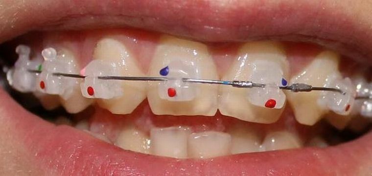 Aparelhagem de cor - uma palavra brilhante na ortodontia