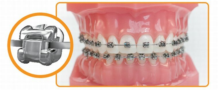 Damono kronšteinai: naujoviška dantų korekcijos sistema
