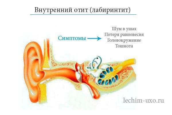 otitis af det indre øre