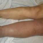 swelling of the legs with thrombosis
