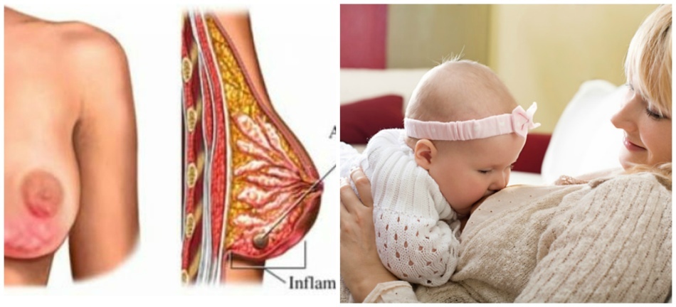 Lactostase hos en ammende moder, hvor fødslen ophører: årsager, symptomer og behandling derhjemme med medicin og folkemidlet. Konsekvenser og forebyggelse af laktostase ved amning. Forskellen mellem laktostase og mastitis