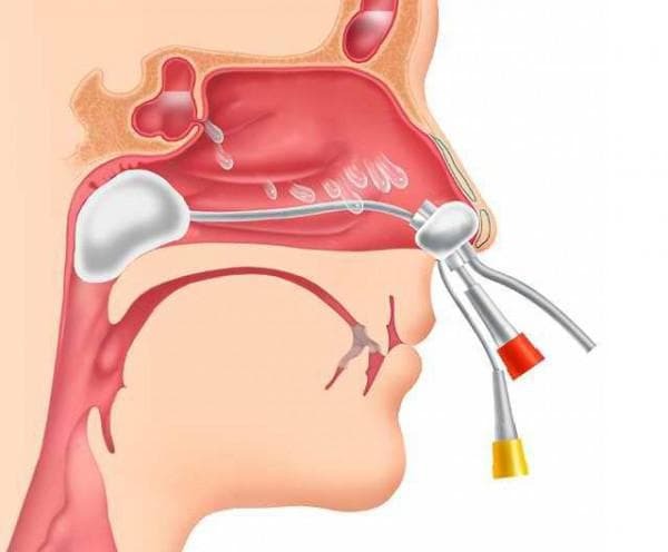 Treatment of sinusitis with the help of a cramp procedure