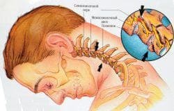 cervical osteochondrosis
