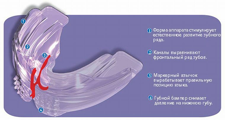 Elastopozitsioner Mirobreis - sebuah alternatif untuk kawat gigi untuk koreksi gigitan