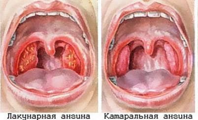 lacunar throat