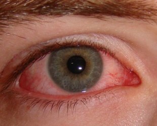 Akių lašai Pilokarpinas skirtas sėkmingam glaukomos ir kitų ligų gydymui