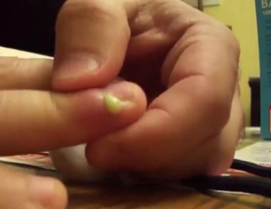 Een abces op de vinger bij de nagel - een wondermiddel: hoe te behandelen? Panaritium vinger bij de hand: behandeling, typen, symptomen, oorzaken