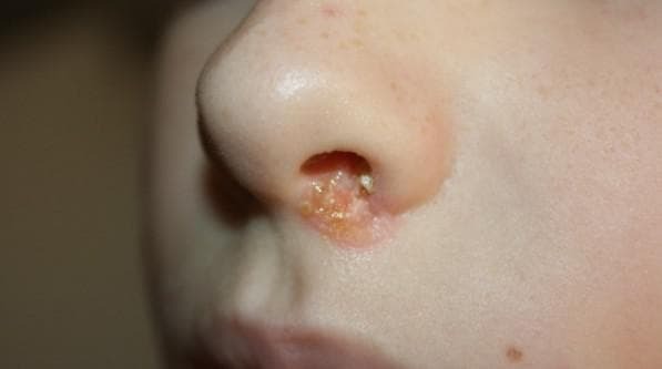 Cortex u nosu uzrokuje i liječenje