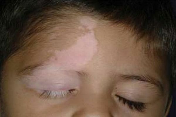 Macchie pigmentate sul viso - le cause del loro aspetto, tipi e metodi di trattamento
