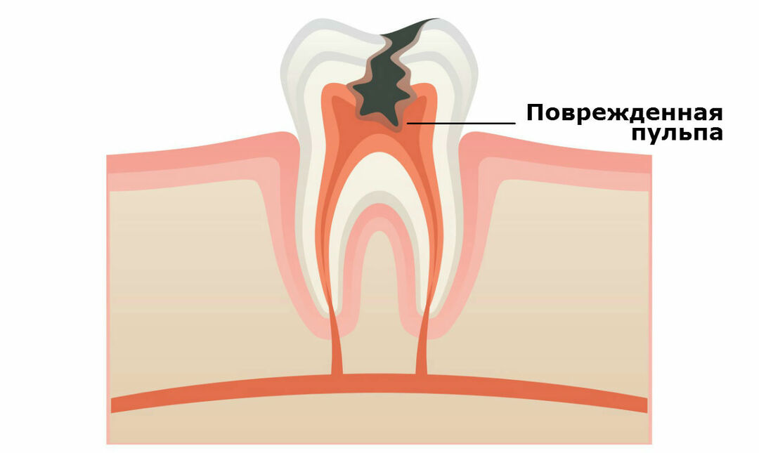 What is pulpitis? Symptoms and signs of pulpitis. Treatment and prevention of pulpitis