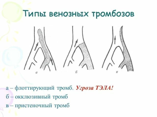 Ką reikia žinoti apie giliųjų ir paviršinių venų okliuzinę trombozę