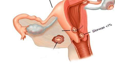 Kohdunkaulan raskaus: mikä on, oireet, kliiniset ohjeet