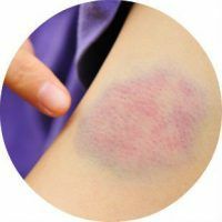 The causes of bruises on the body in women, men and children without bruises