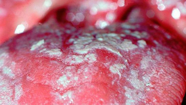 Kada se gljiva smjestila u ustima - simptomi i liječenje dojki u odraslih