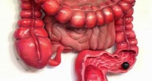 polyps in the rectum