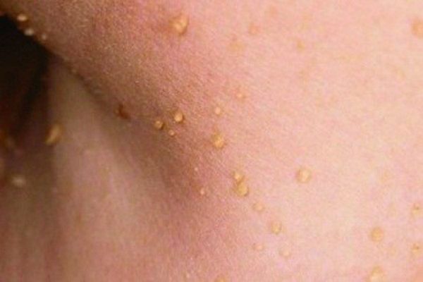 Mis on naha tüükad ja kuidas nad välja näevad?