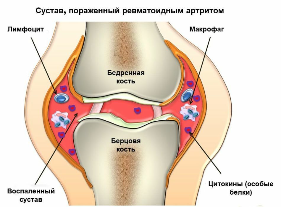 Liečba chorôb kĺbov. Prípravky a vitamíny na ochorenia kĺbov na liečbu a posilnenie chrupavky a väzy
