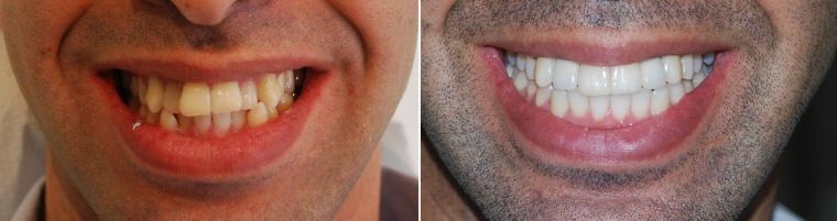 Le principe de l'action des plaques orthodontiques pour l'alignement des dents