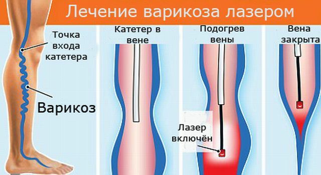 Варикоз Лечение Эвлк Отзывы