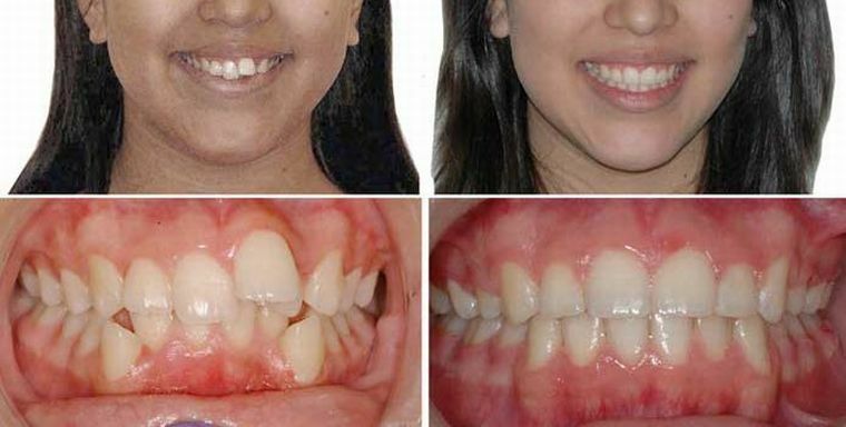 שיניים צפופות - גורם, טיפול, מניעה ותוצאות