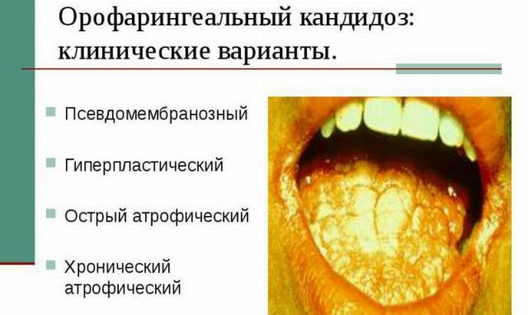 La candidiasis orofaríngea es un aftas que toca las membranas mucosas de la boca y los labios